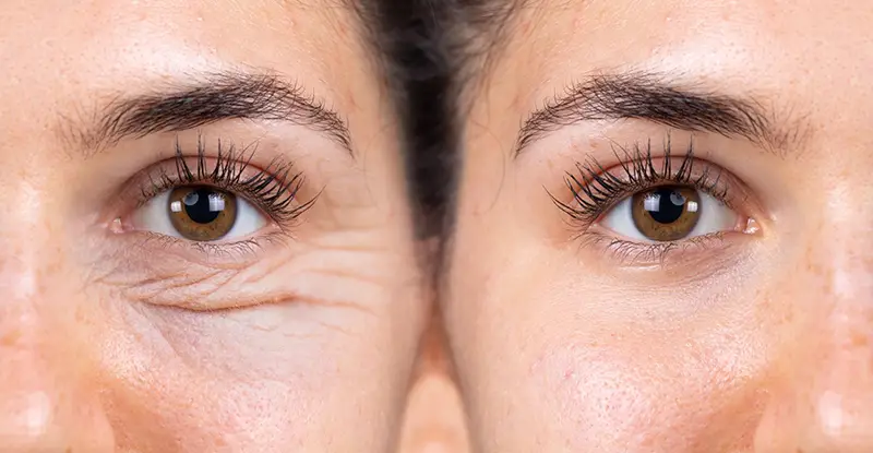 Blefaroplastia, înainte și după