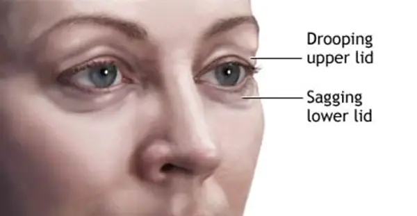 Desen explicativ care ilustrează problemele de la nivelul pleoapelor