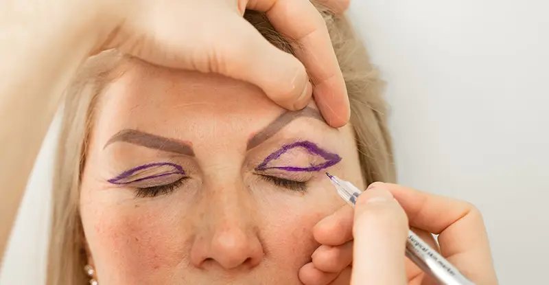 Un medic desenează pe pleoapele pacientului înainte de o procedură de blefaroplastie.