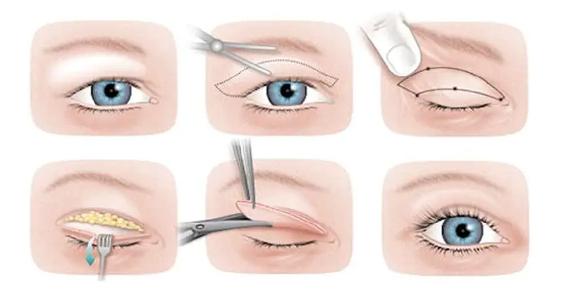 Desen care ilustrează pașii procedurii de Blefaroplastie