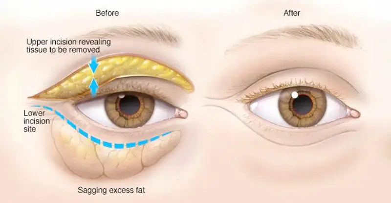 Desen care ilustrează inciziile efectuate în procedura de Blefaroplastie