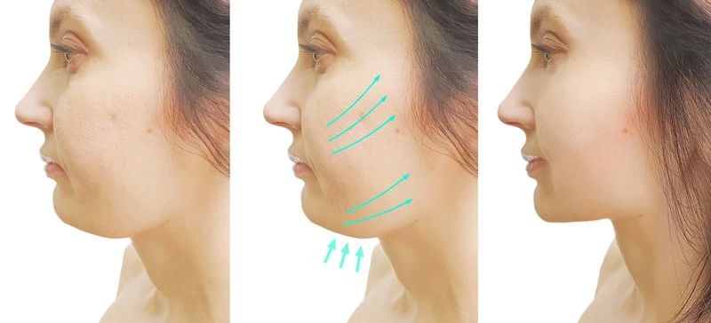 O ilustrație a lipoaspirației de gât